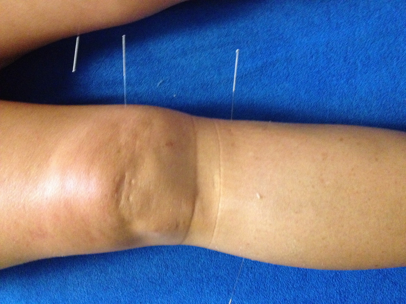 Akupunktúra kolena